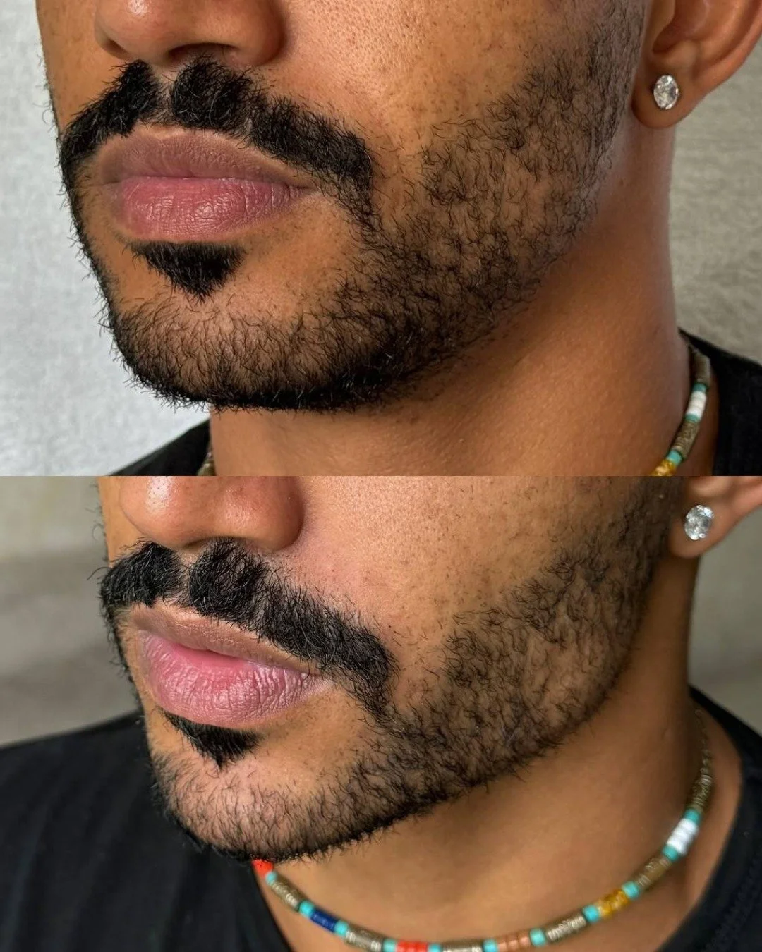 botox before and after Gold Coast Chicago 