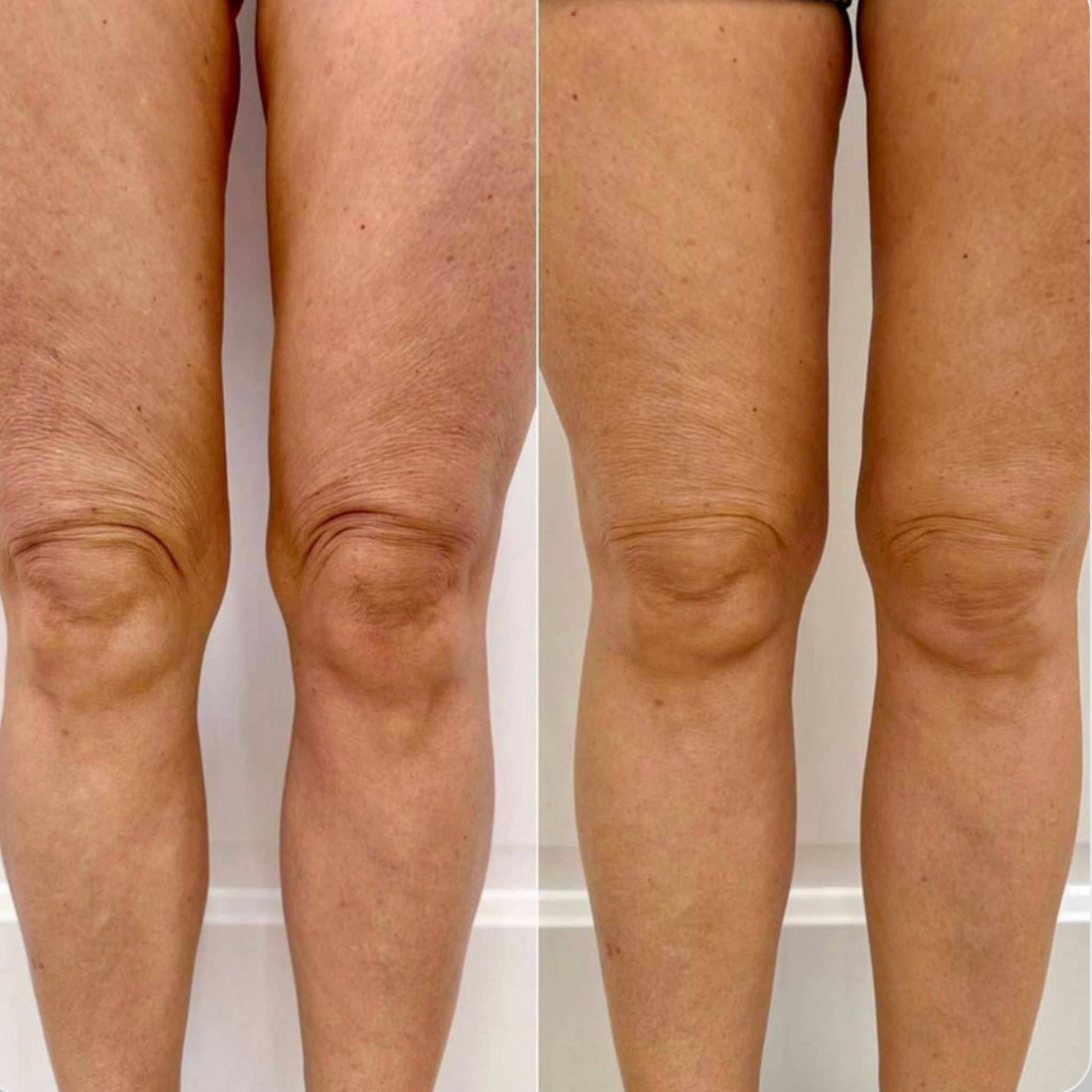 Chicago Before and After weight loss and cellulite treatment on legs and knee tightening 