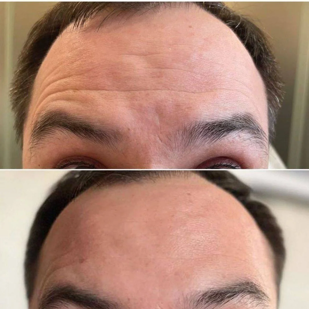 Botox Before and after Gold Coast Chicago
