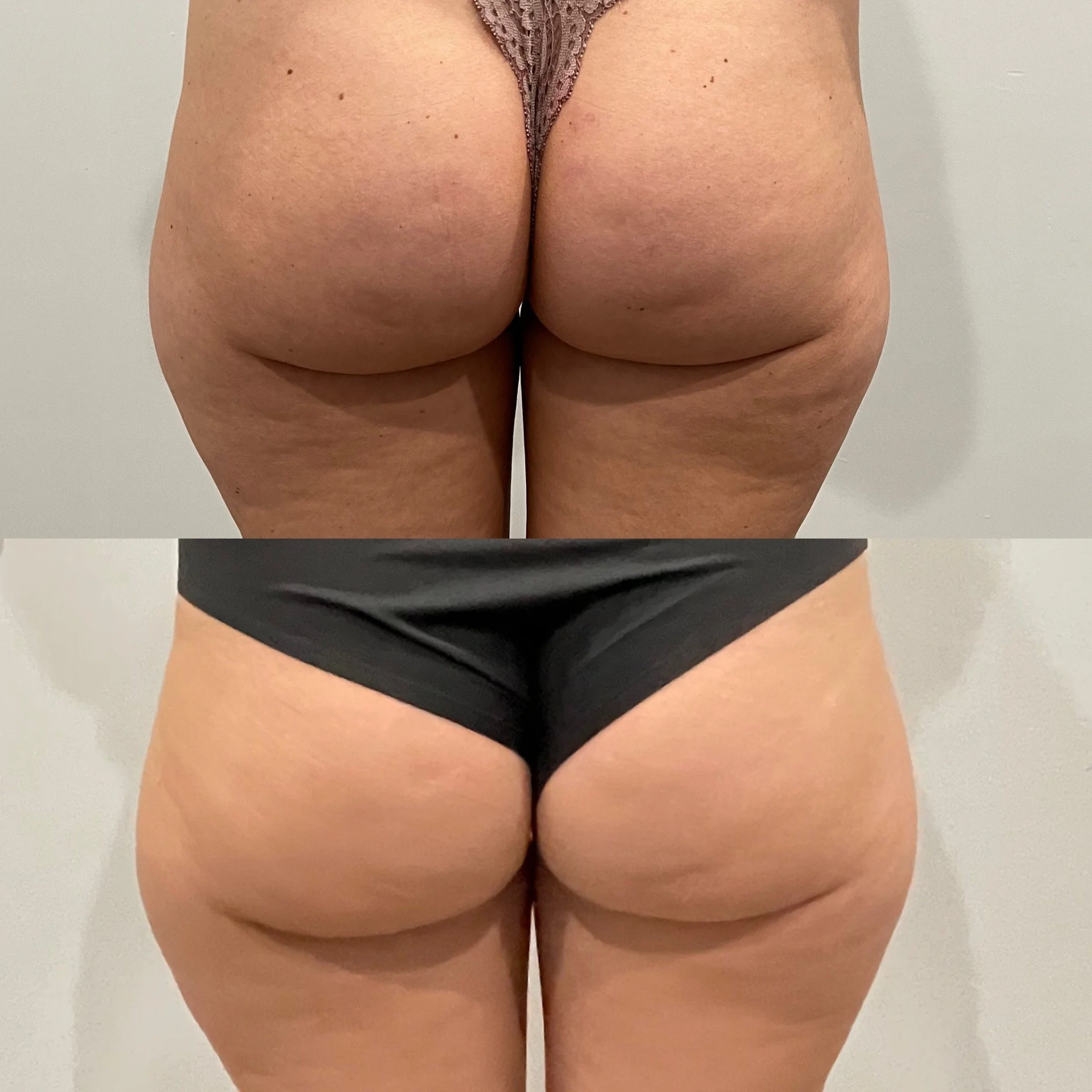 Chicago before and after weight loss and cellulite reduction