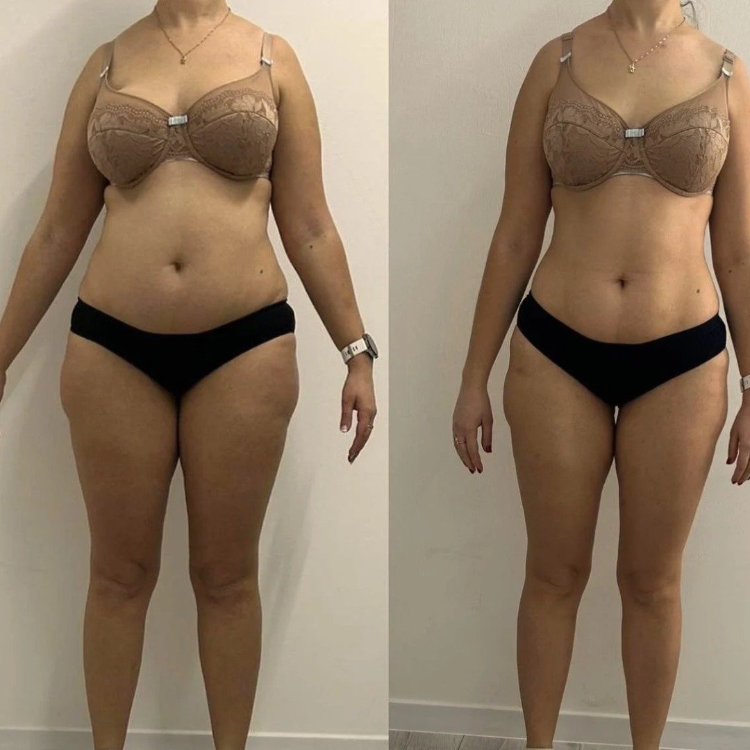 Chicago before and after weight loss and cellulite reduction
