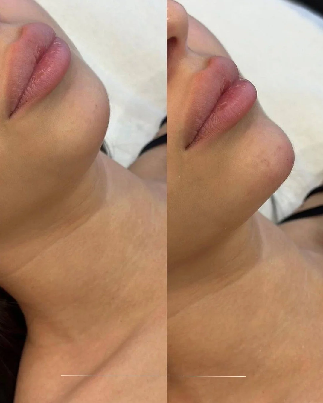 Botox before and after Gold Coast chicago