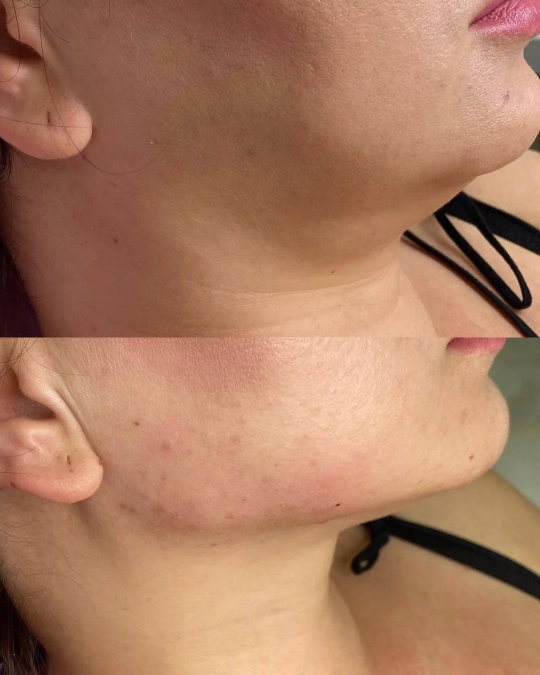 Botox before and after Gold Coast chicago