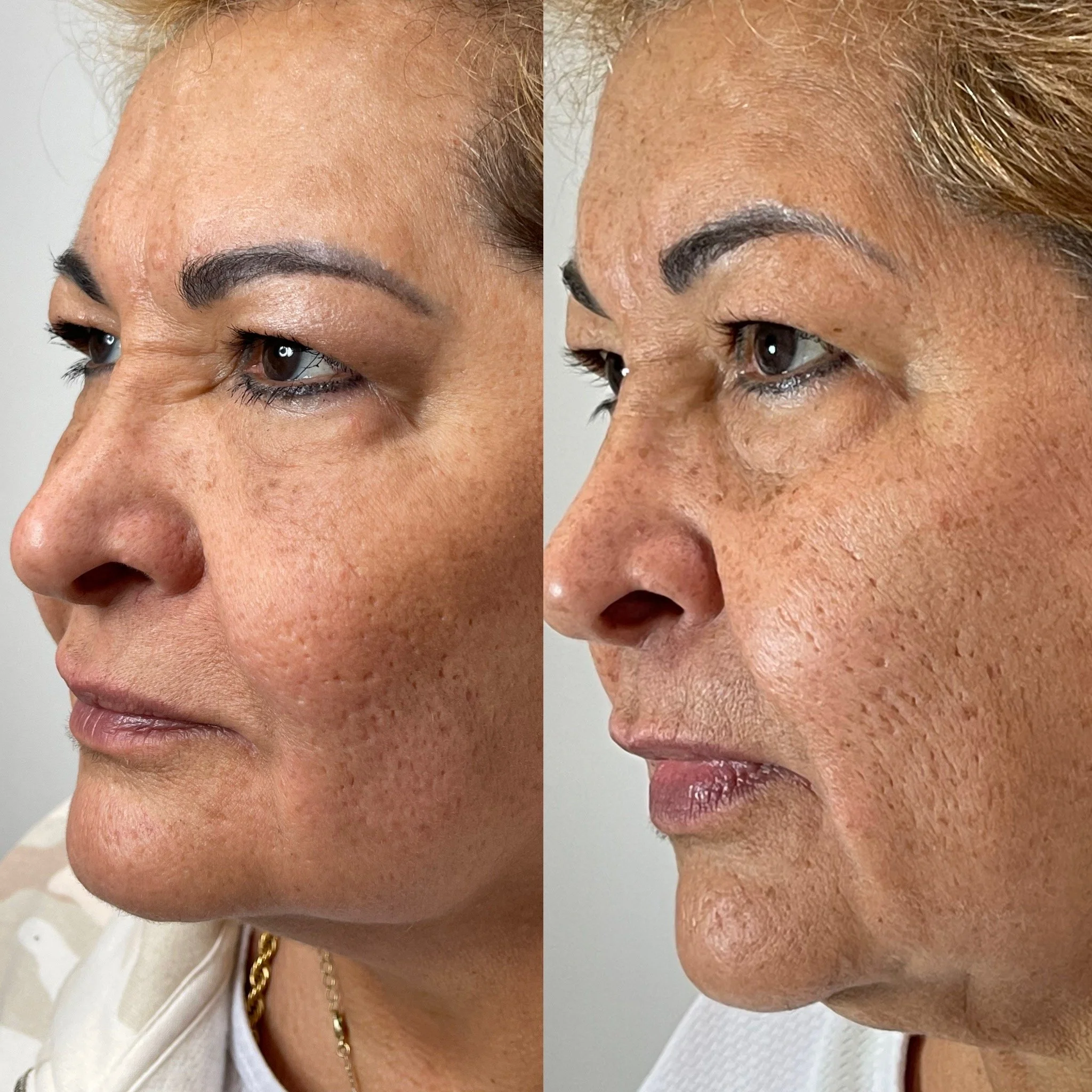 before and after skin tightening Chicago 