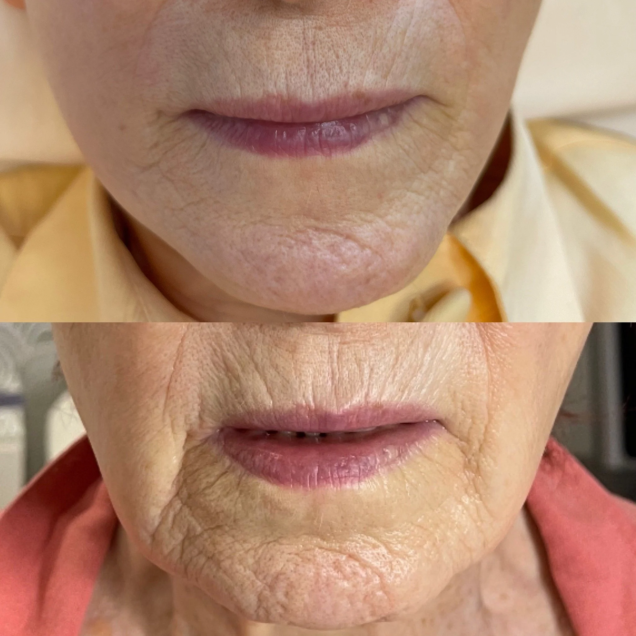 before and after plasma pen Chicago Gold Coast