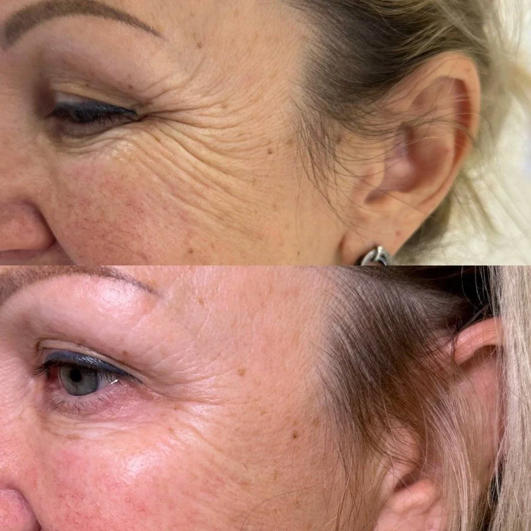 botox before and after Gold Coast Chicago 