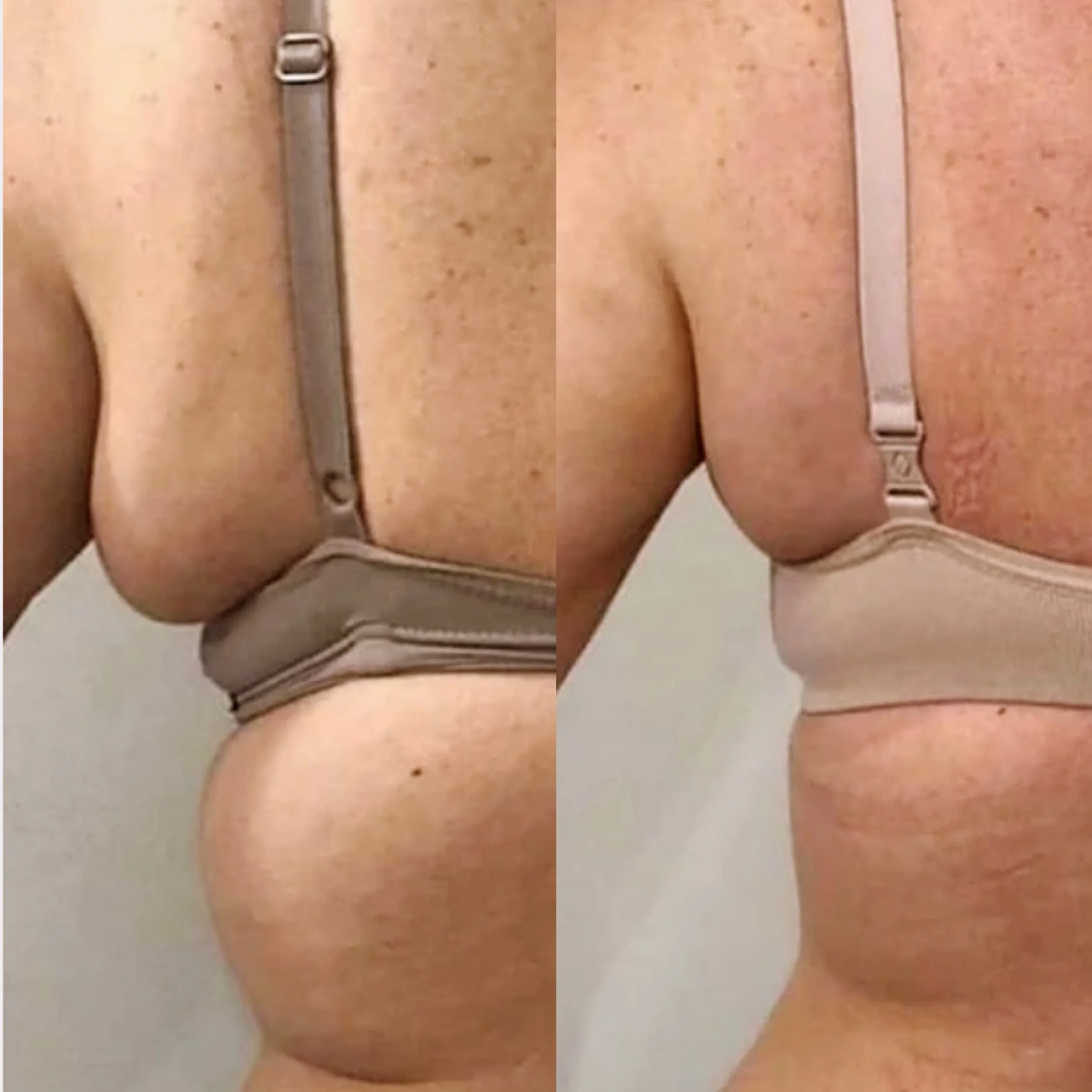 Chicago before and after weight loss treatment 