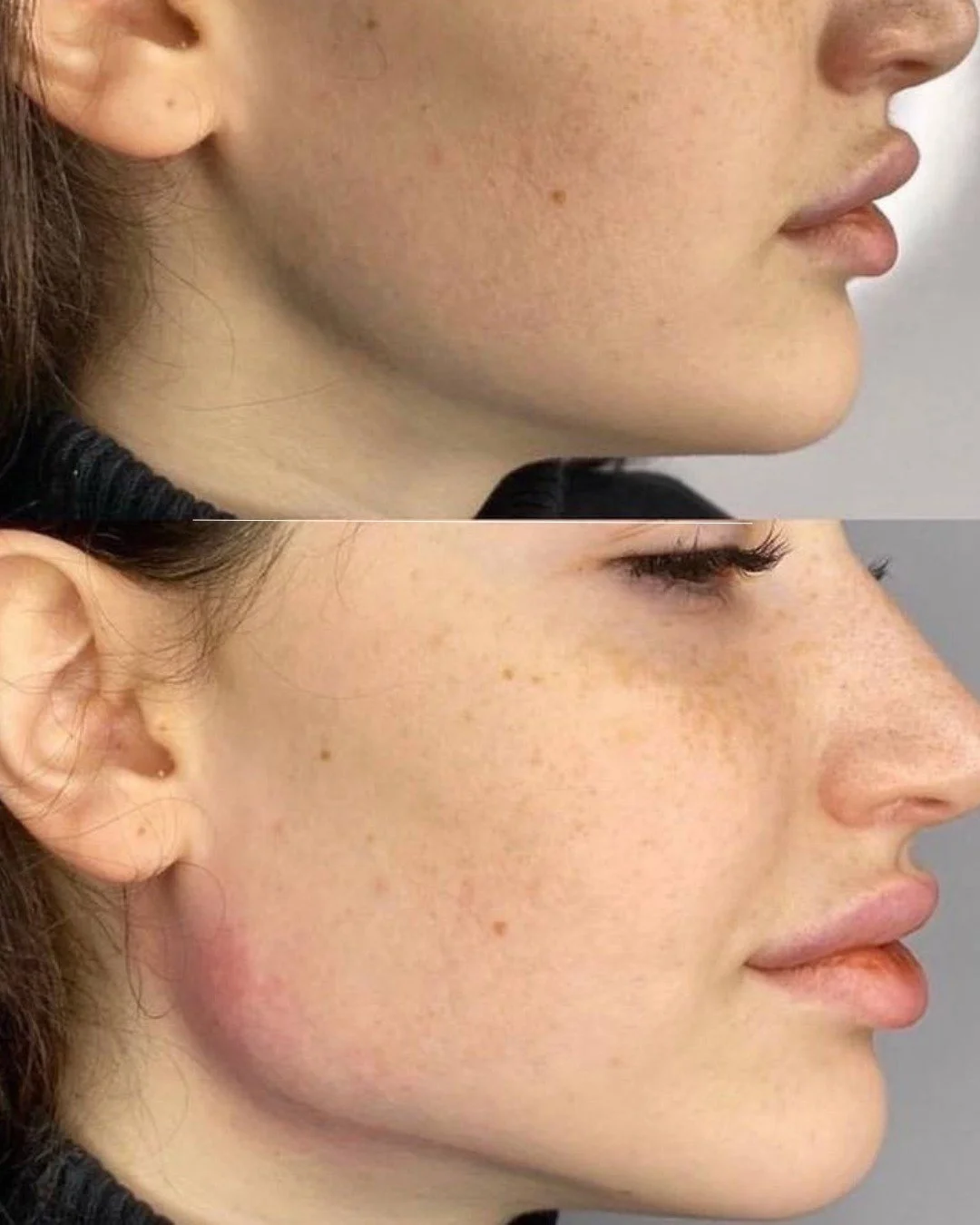 Botox before and after Gold Coast Chicago 