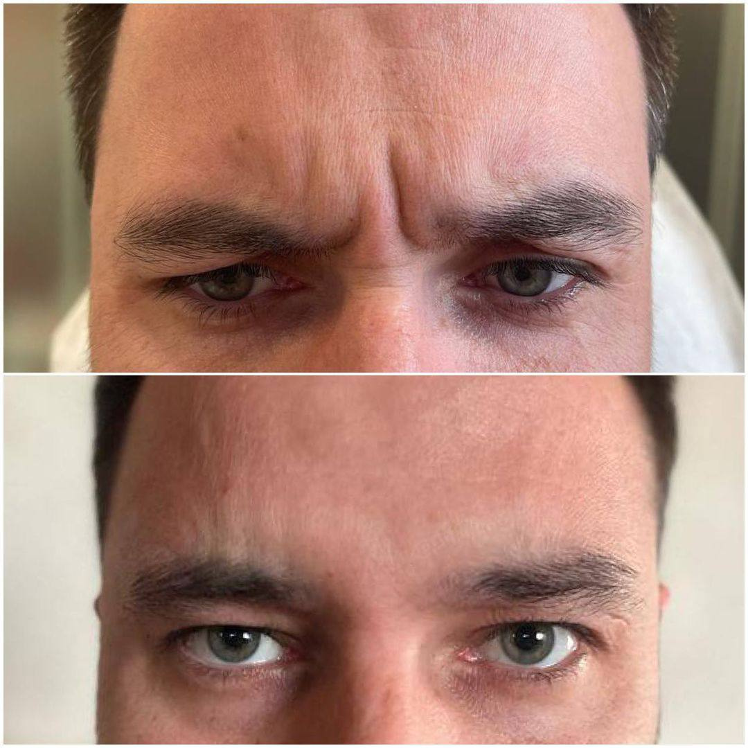 botox before and after Gold Coast Chicago 