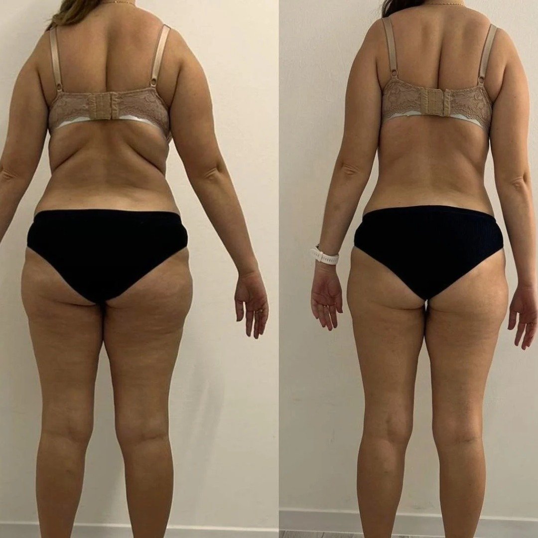 Chicago before and after weight loss treatment 