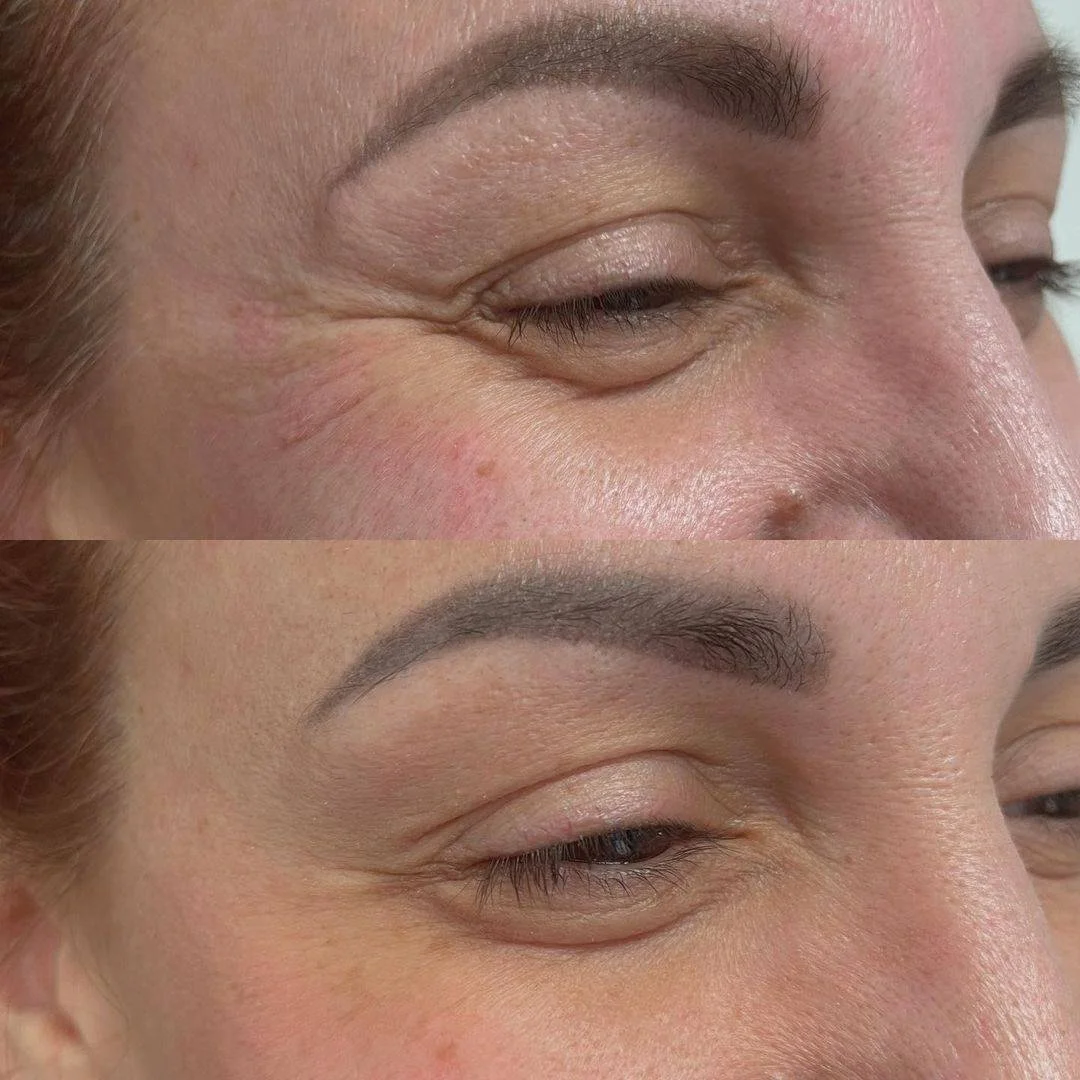 Botox before and after Gold Coast chicago