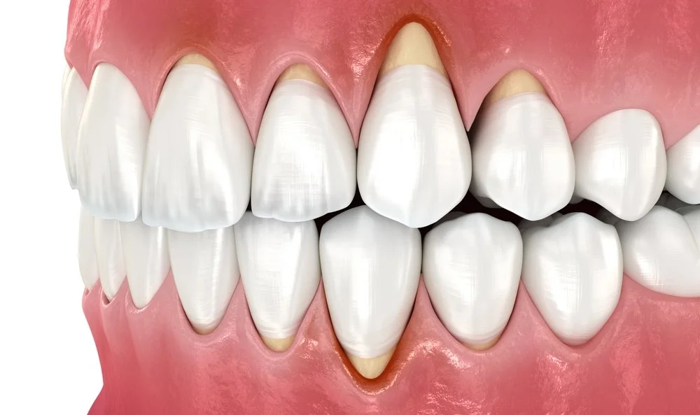 receding gums exposing tooth roots and showing need for gum recession treatment