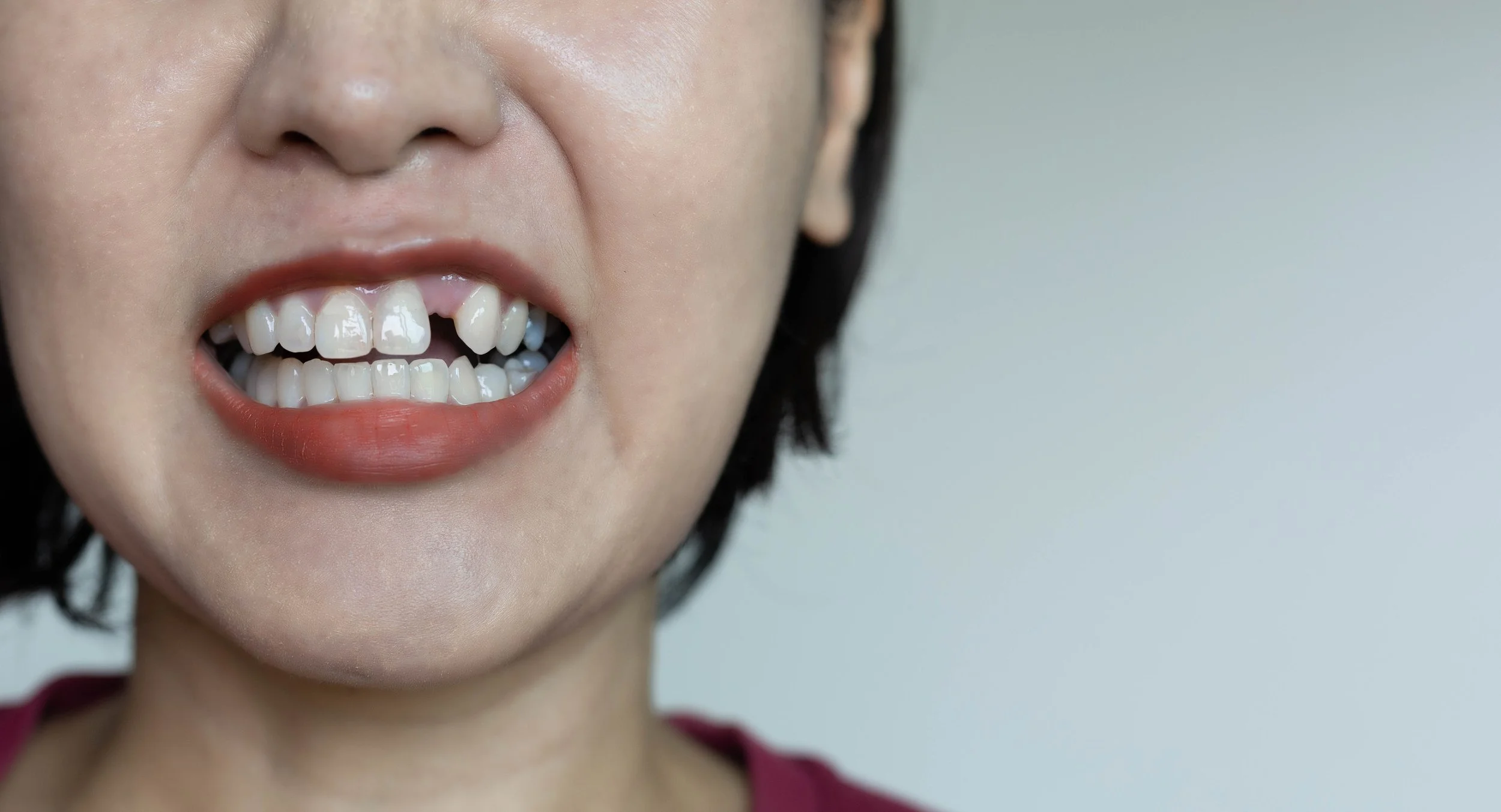 The Long-Term Effects of Not Replacing Missing Teeth