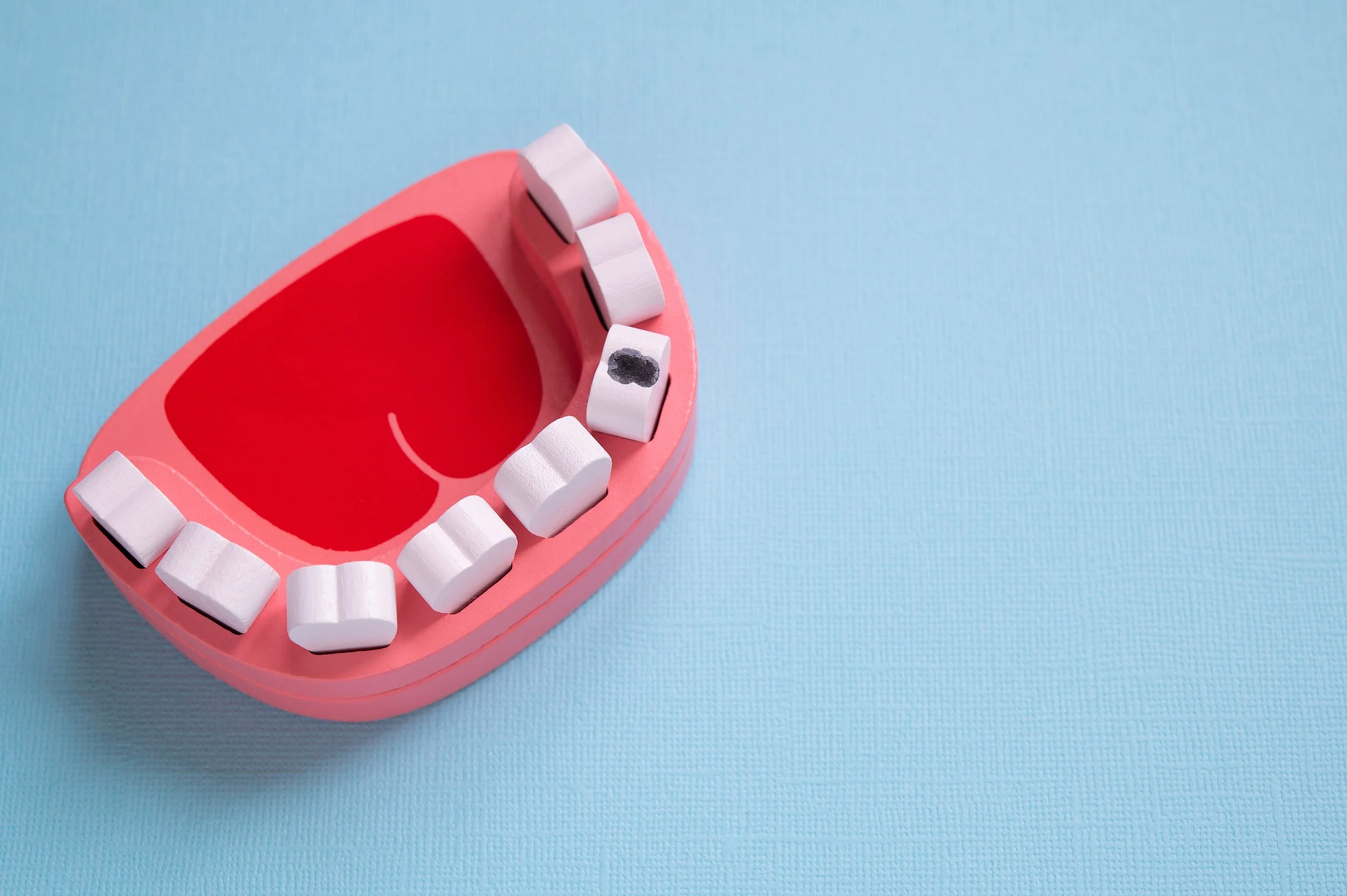 The Importance of Early Cavity Detection for Long-Term Oral Health