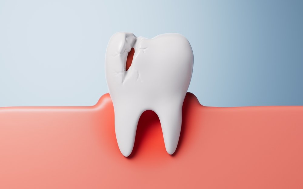 How to Tell If a Cracked Tooth Needs Treatment