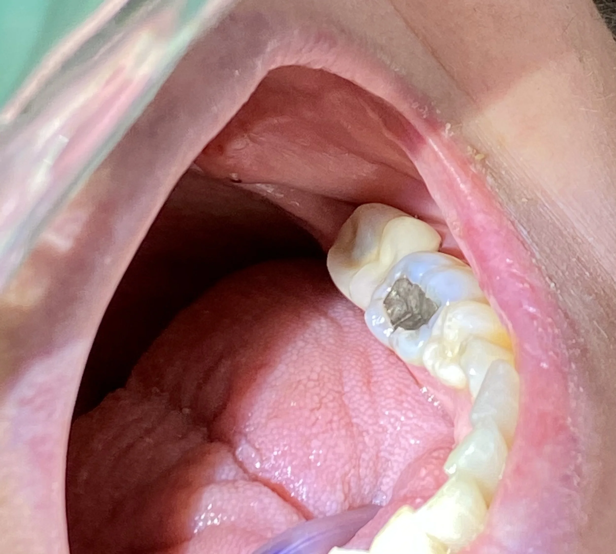 Close-up of an open mouth showing teeth and a dental filling.