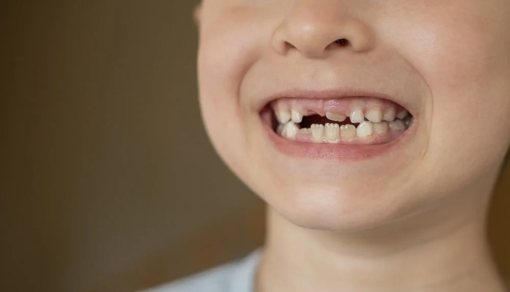 shark teeth in children with a permanent tooth growing behind a baby tooth