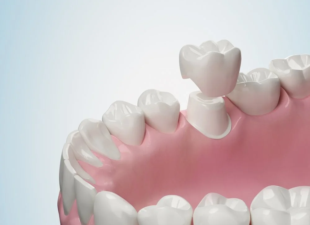 dentist explaining dental crown placement after root canal treatment