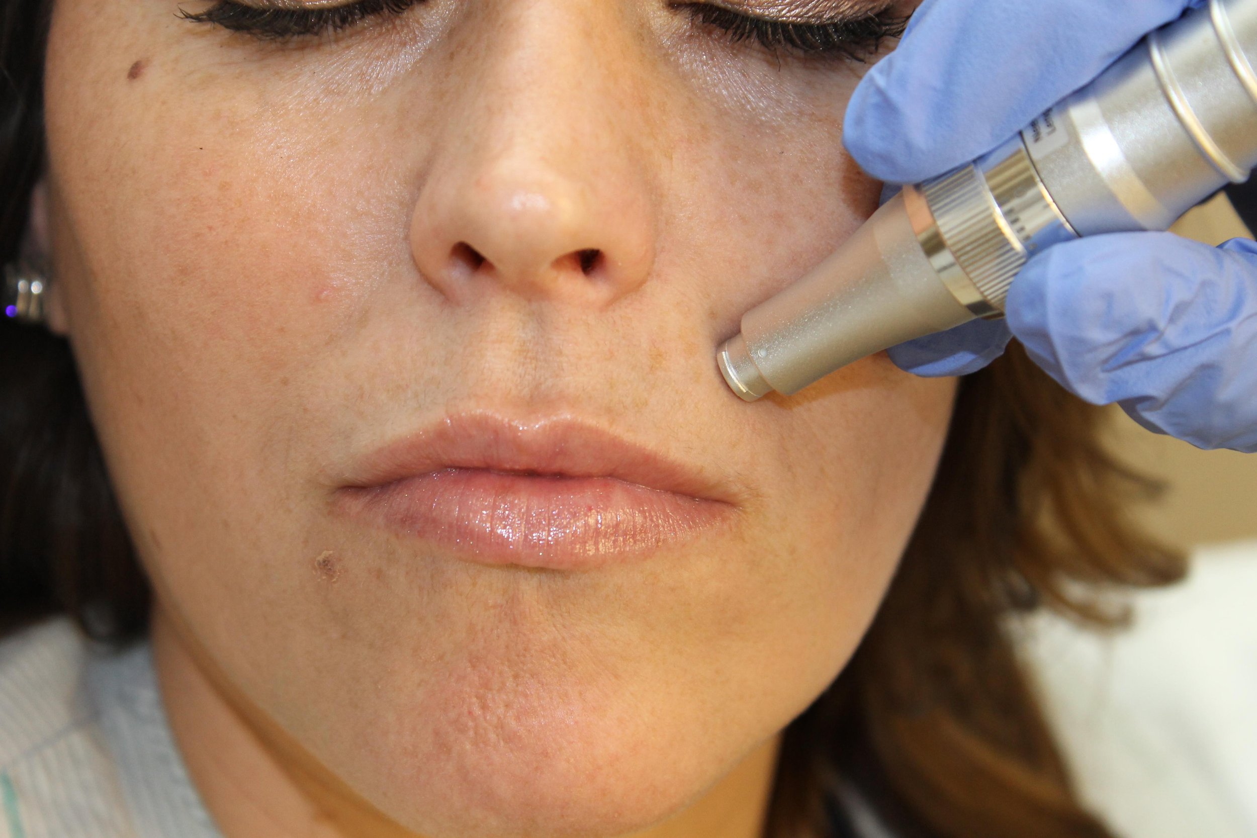 How Microneedling Works to Reduce Acne Scars and Fine Lines