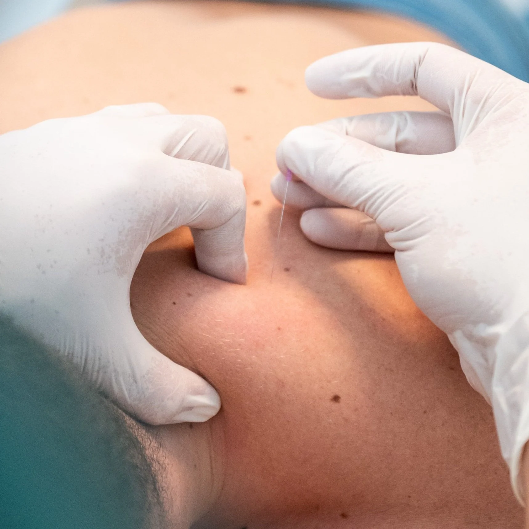 Séance de dry-needling sur points trigger au Centre MOP à Lausanne