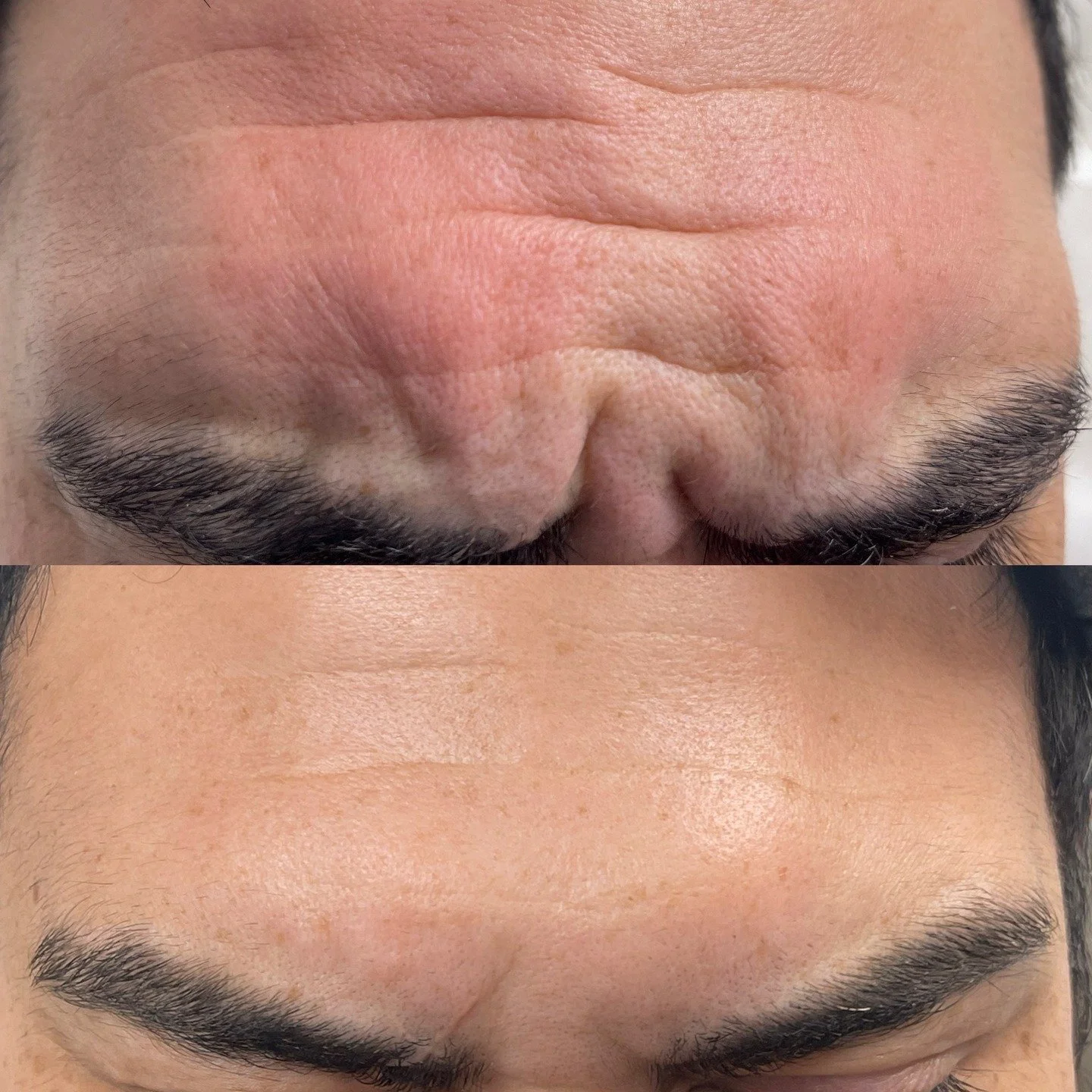 Toxin Tuesday before and afters. 

Botox treatment is a quick procedure performed by injecting the Botulinum toxin into specific muscles using a fine needle, causing a mild pinching sensation. 

You can expect a consultation before the injections, fo