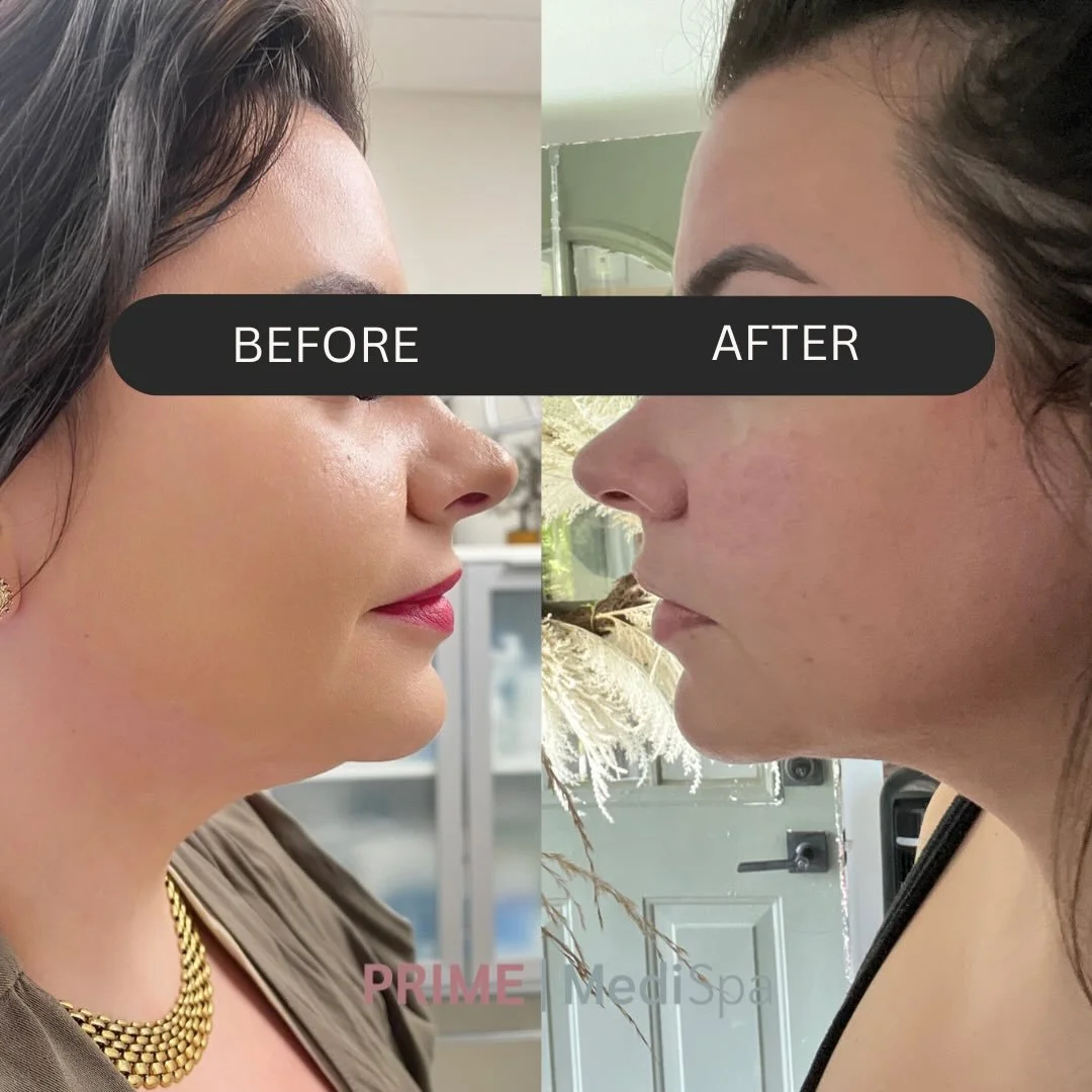 This transformation showcases the power of Kybella. 

The stubborn fat pocket beneath the chin is visibly reduced, revealing a more sculpted jawline and cleaner facial profile.

Kybella permanently destroys fat cells &mdash; once they&rsquo;re gone, 