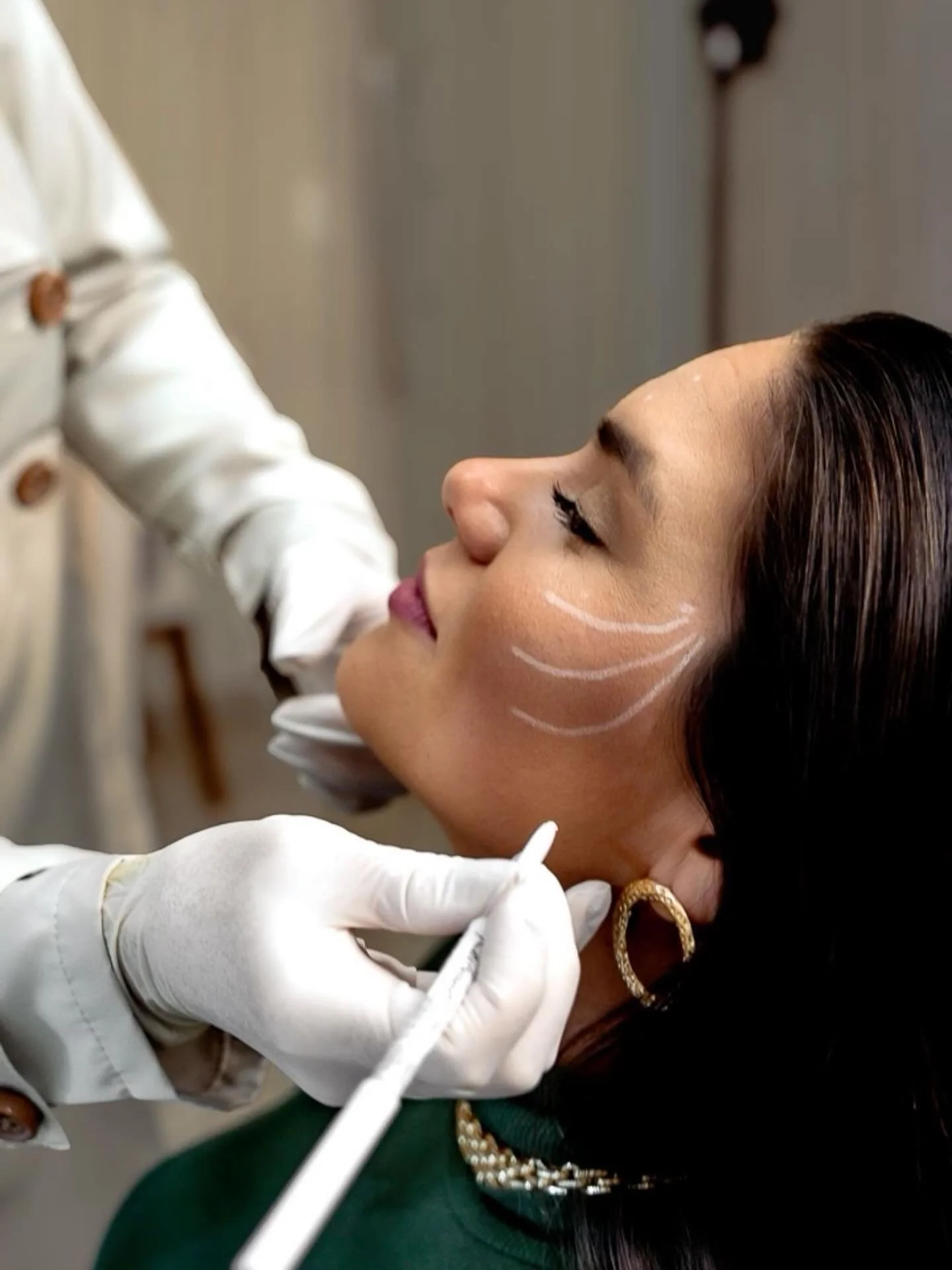 Lift. Sculpt. Restore. ✨

PDO threads for the upper cheeks help elevate sagging skin, enhance natural contour, and restore youthful structure &mdash; all without surgery. By stimulating collagen production, this treatment delivers an immediate lift w