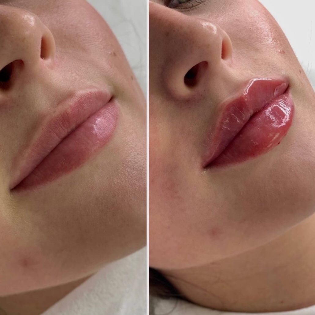 Another beautiful lip filler before &amp; after ✨

Subtle volume, soft definition, and a shape that still feels you&mdash;just refreshed.

The goal is always balance, hydration, and natural-looking results 💉

Thinking about enhancing your lips or ju