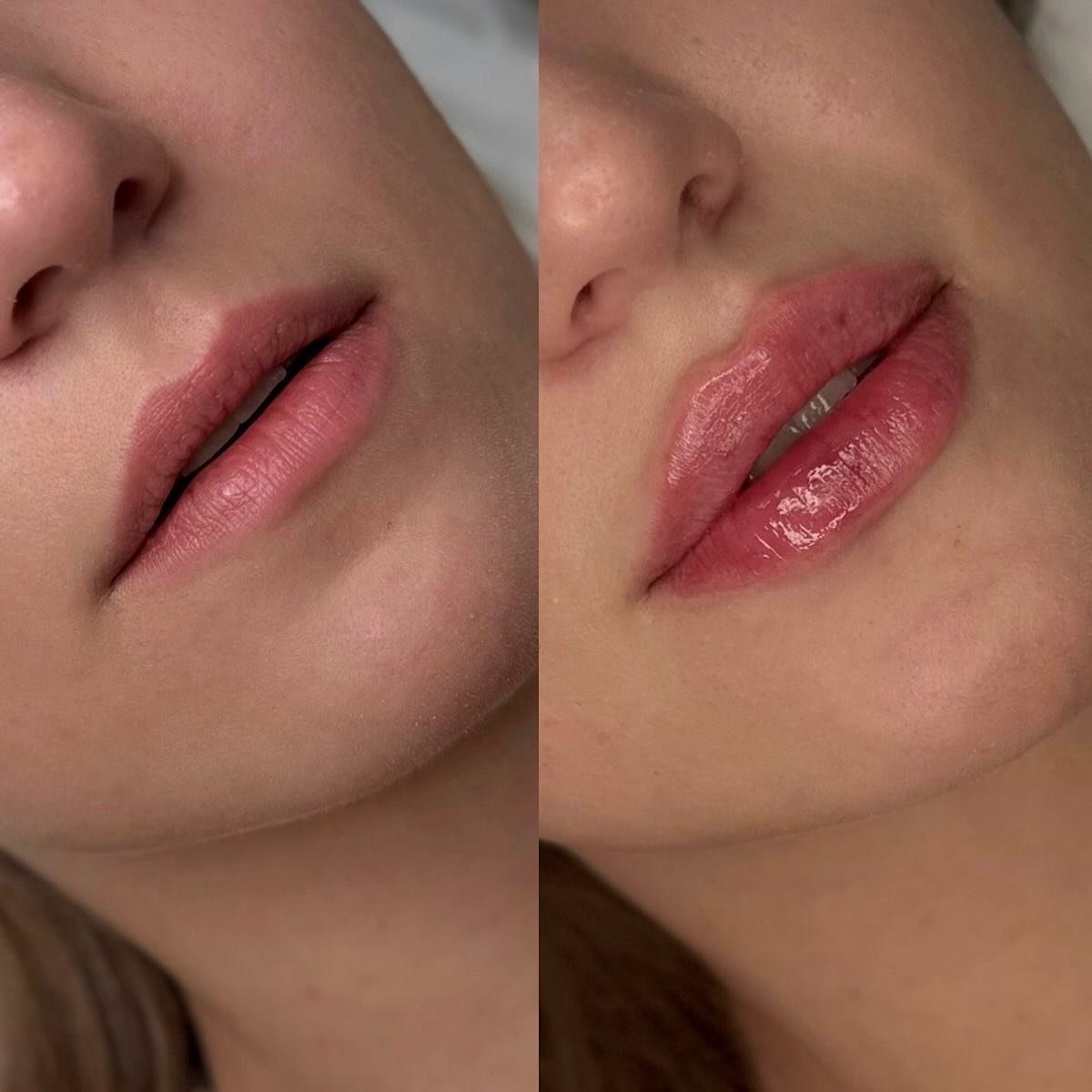 Nothing like a little lip filler to make you feel like a new woman 💋