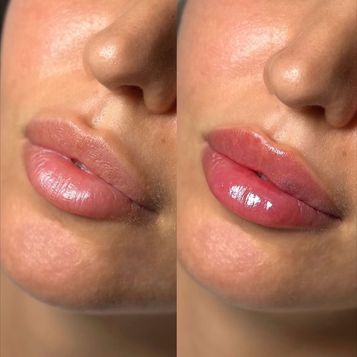 Hump Day Plump 💋

The perfect midweek refresh. Lip filler designed to enhance your natural shape and give you that effortless, hydrated pout.