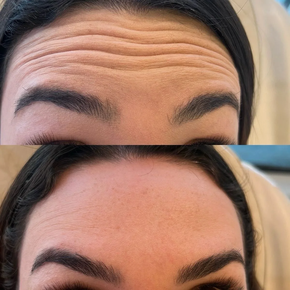 If you haven&rsquo;t gotten botox yet, what are you waiting for?