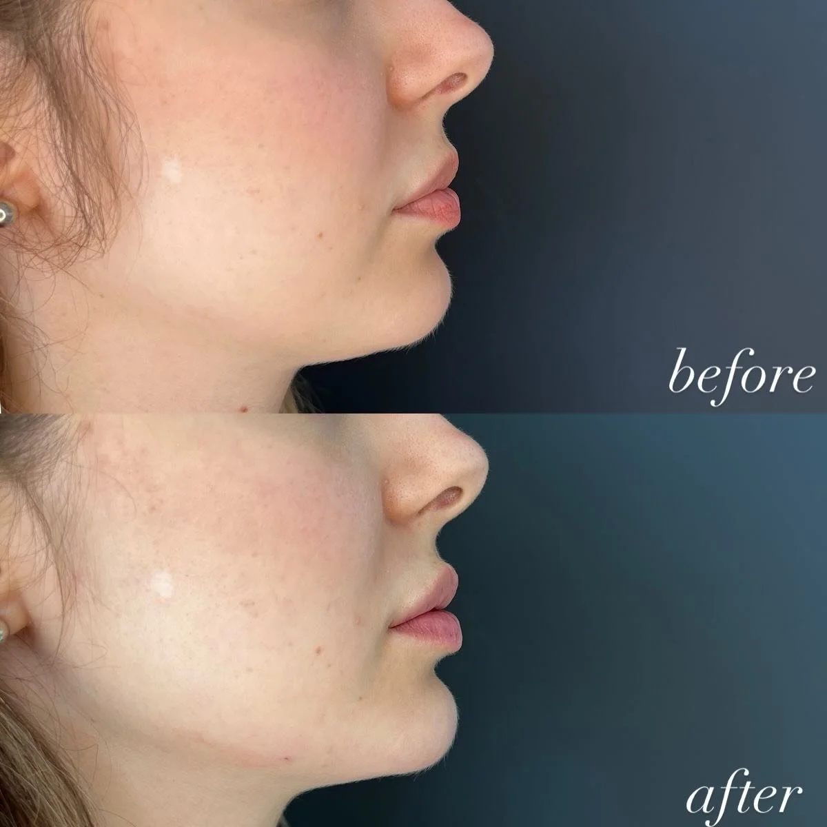 A little lift goes a long way. 💫

PDO threads stimulate collagen, redefine contours, and deliver subtle, stunning results &mdash; just like this before &amp; after.

Curious if you&rsquo;re a candidate?
Tap the link in bio to book a consultation.