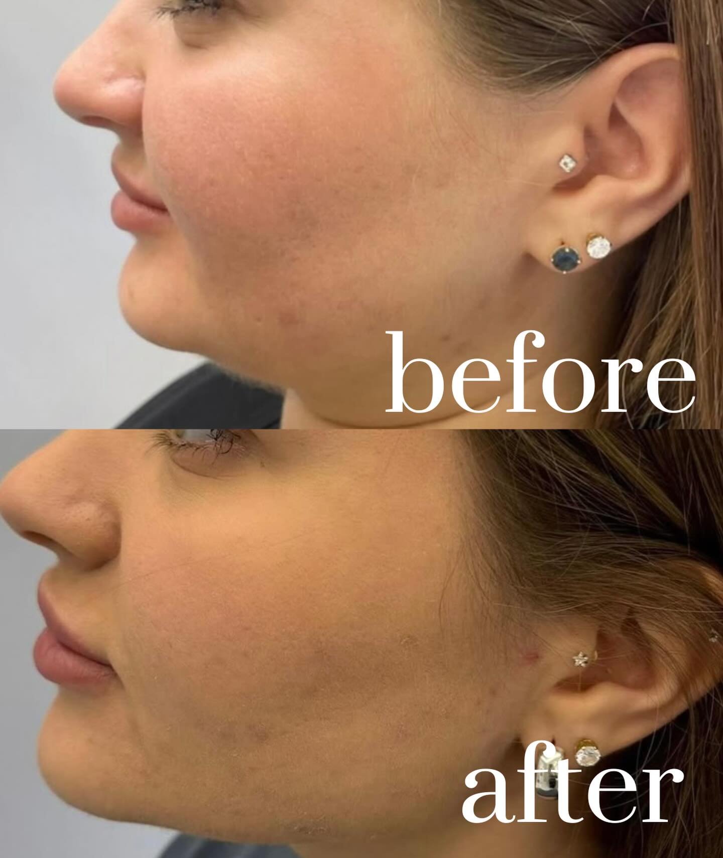 Snatched, sculpted, and still natural 💫

At Prime MediSpa, your jawline glow-up is never one-size-fits-all. We combine advanced treatments to contour, tighten, and define &mdash; all tailored to YOU.

✨ Kybella to dissolve stubborn under-chin fullne