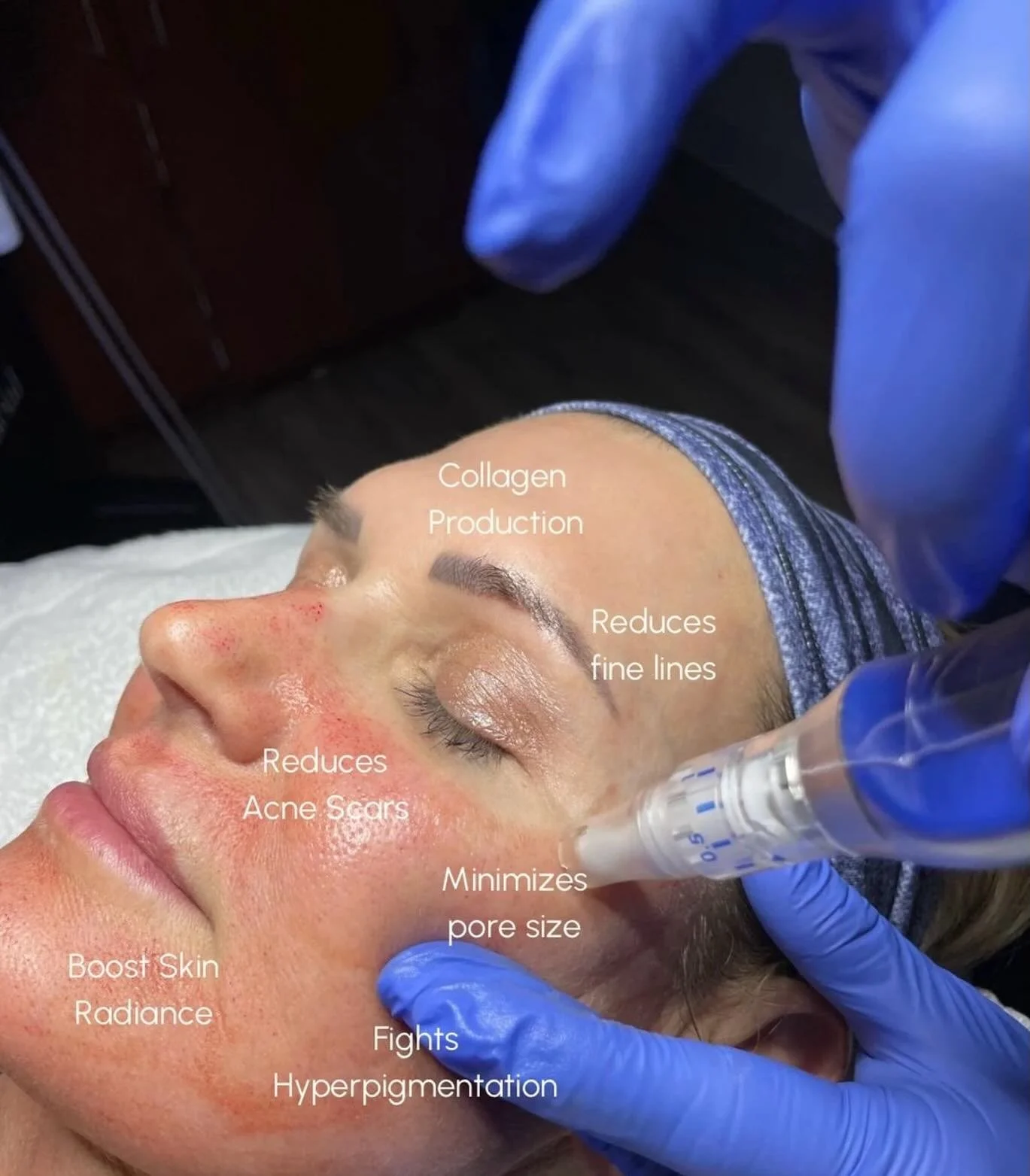 #Microneedling is one of our favorite treatments for improving overall skin texture and radiance while stimulating natural collagen production. Benefits include:

&bull; Reducing fine lines + wrinkles
&bull; Minimizing pores
&bull; Improving acne sca