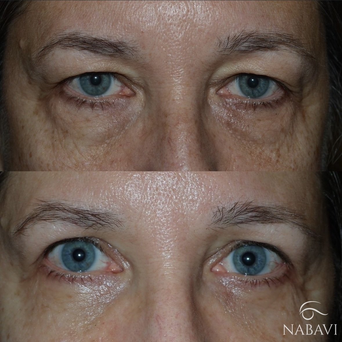 Upper and Lower Lid Blepharoplasty