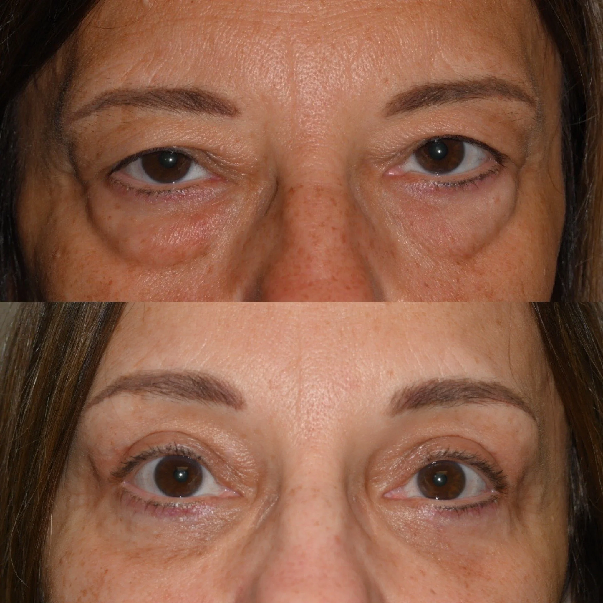 Before and after brow lift, upper lid ptosis repair and lower blepharoplasty with Dr. Nabavi in Columbus, Ohio