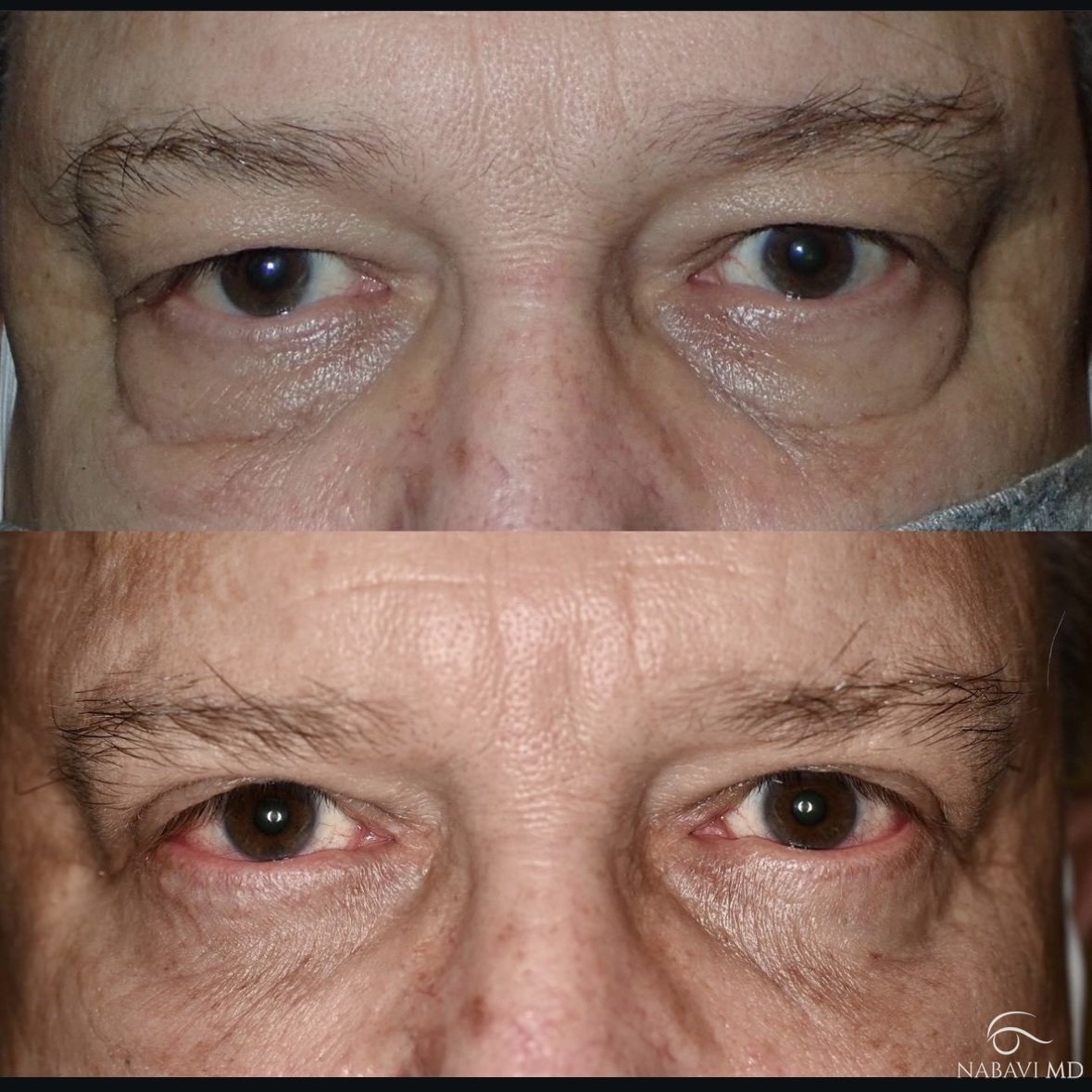 Upper and Lower Lid Blepharoplasty