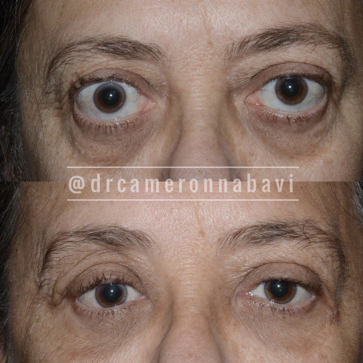 Before and After Orbital Decompression for Thyroid Eye Disease