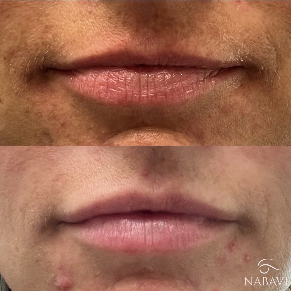 Lip Augmentation With Filler