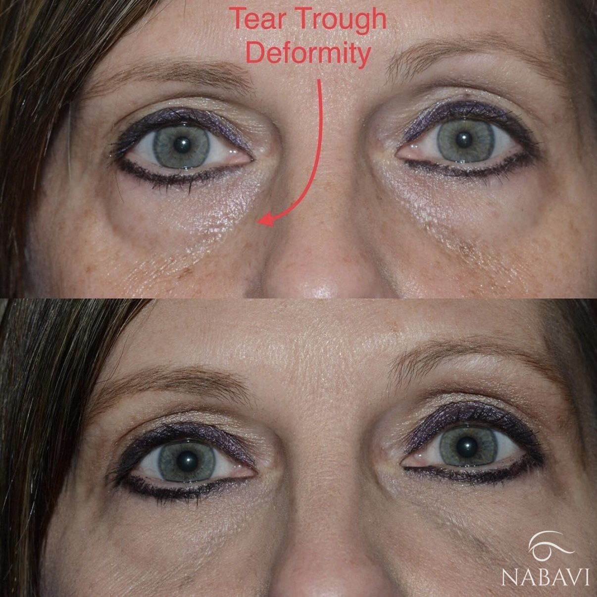 Tear Trough Filler