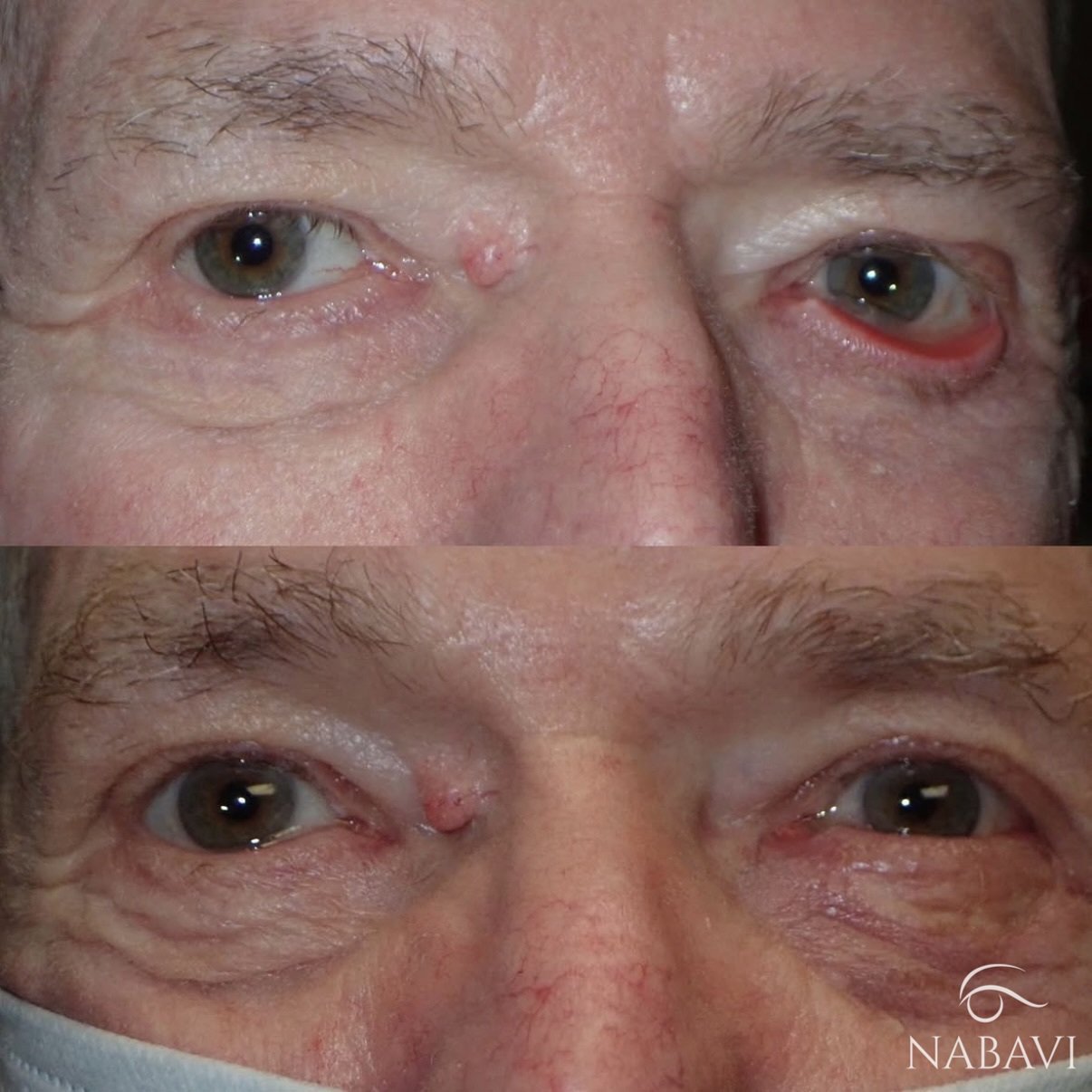 Lower Lid Ectropion Repair