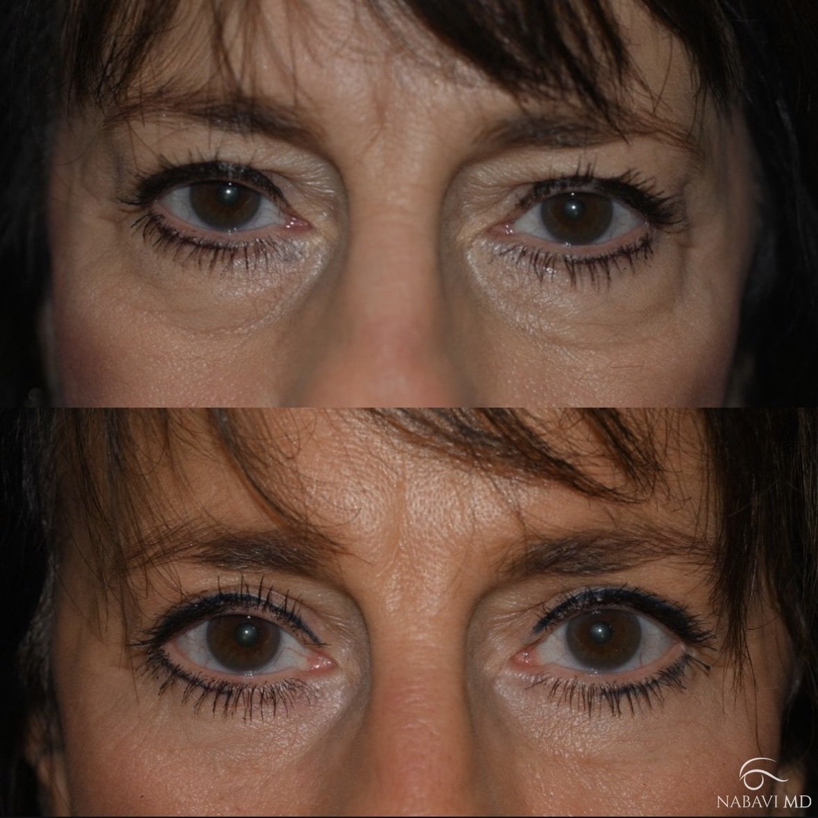 Lower Lid Blepharoplasty