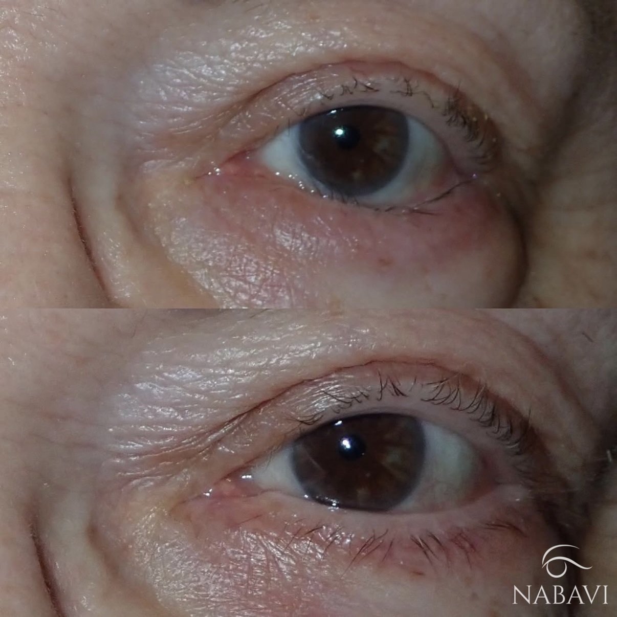 Lower Lid Entropion Repair