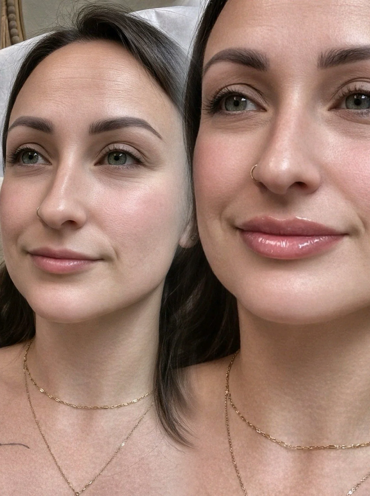 Lip Filler 