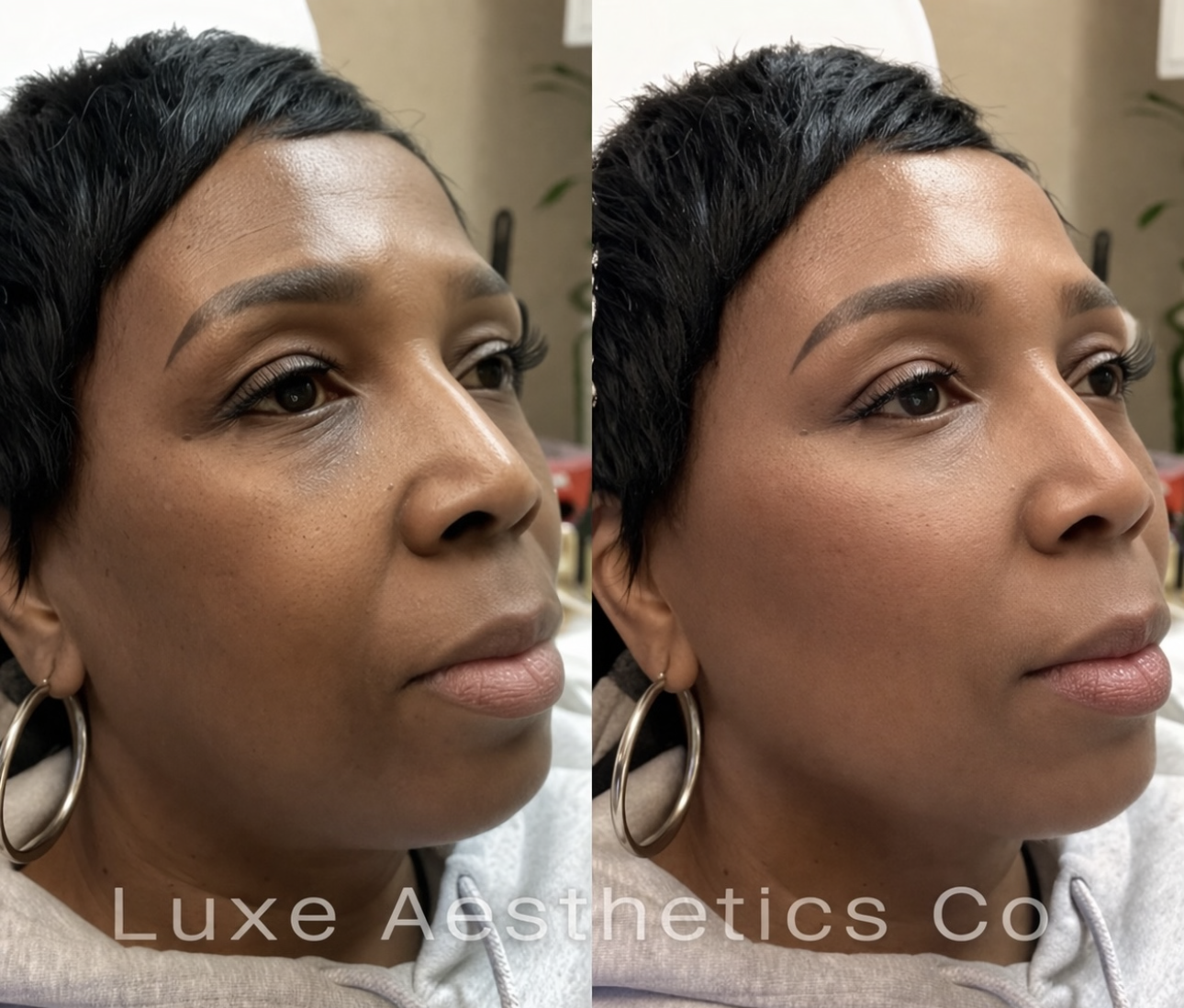 cheek fillers .png
