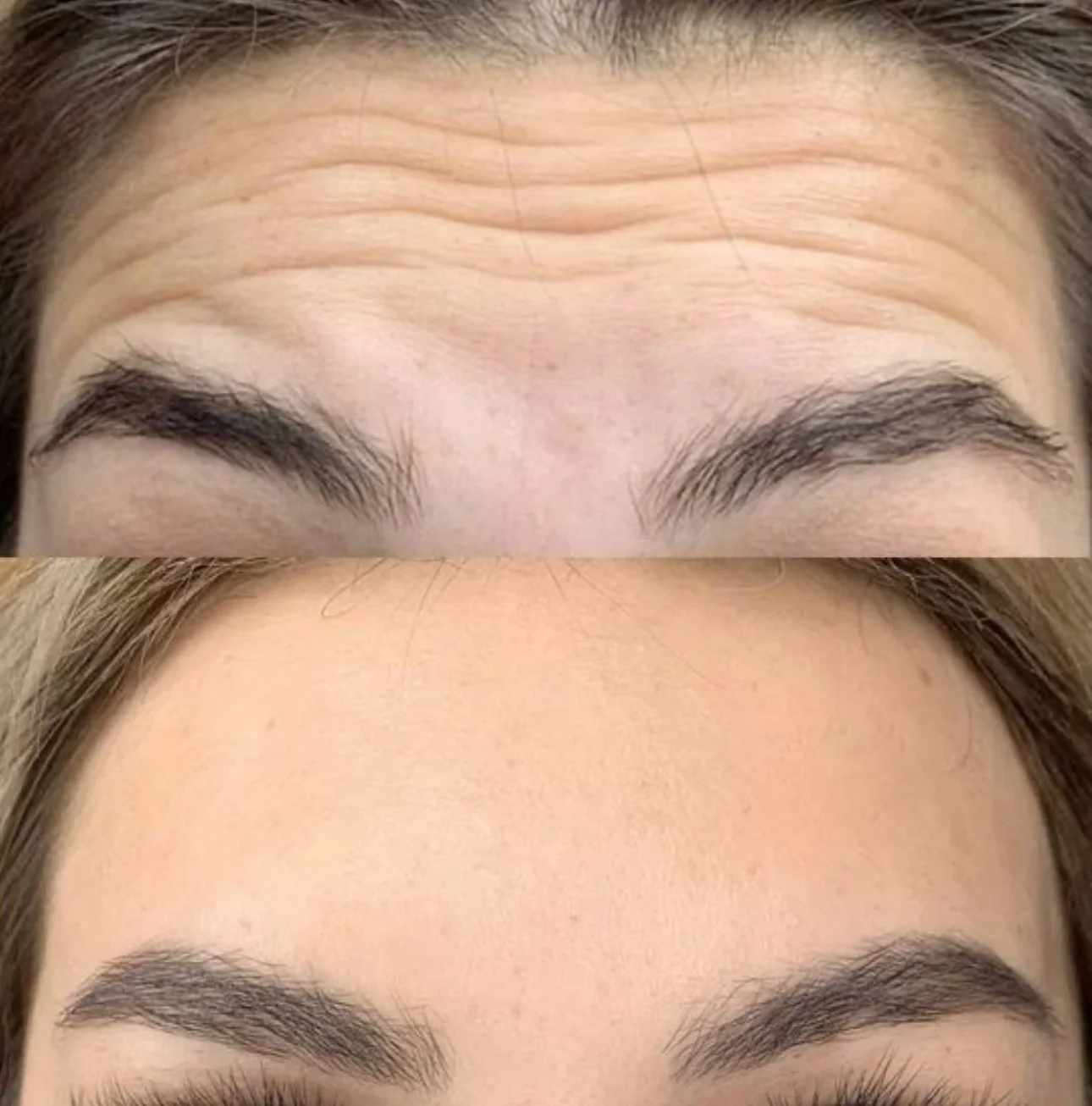 botox .jpg