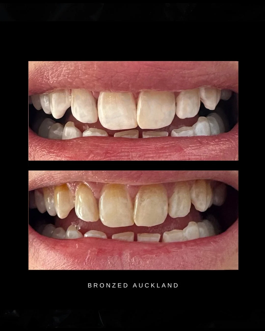 This is what one session can do ✨ 
Dental-grade, zero pain, and we come to you.

#teethwhiteningauckland #aucklandteethwhitening #aucklandbeauty #teethwhitening
