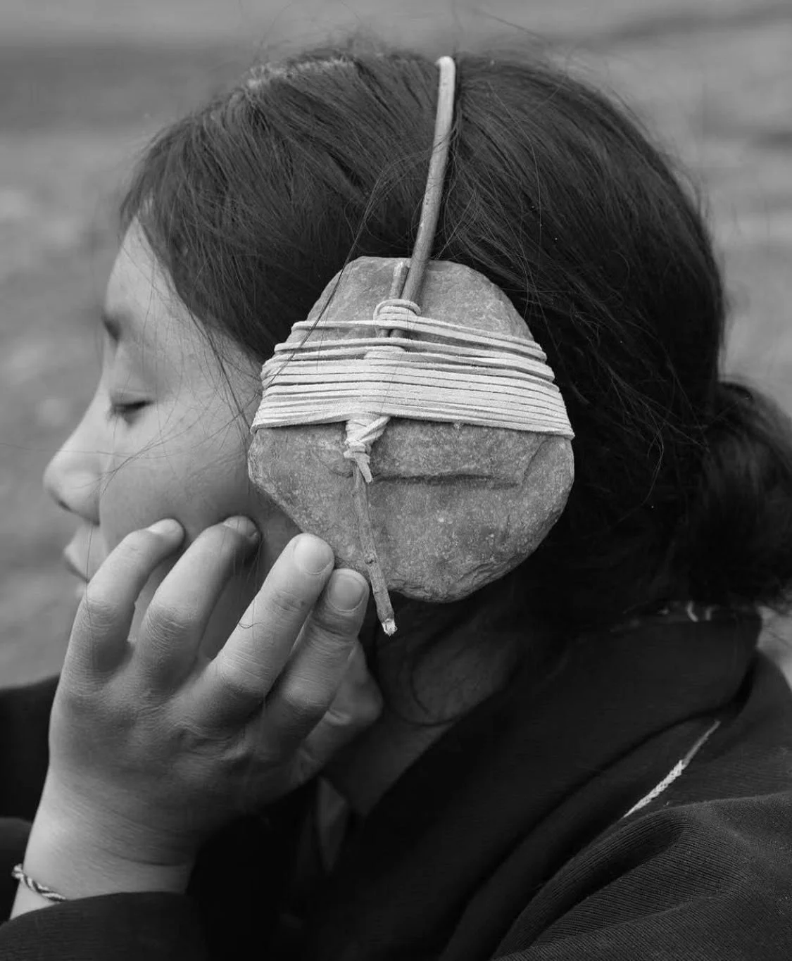 How Acupuncture Calms an Overactive Mind