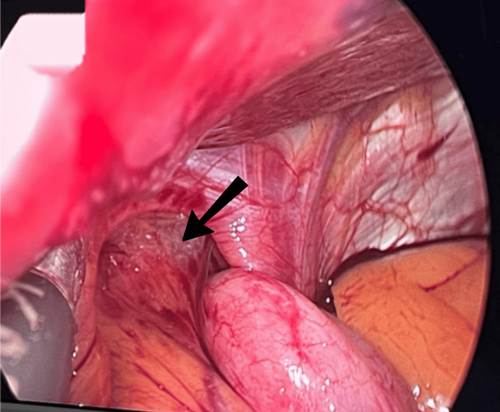 Close-up view of inside of a human mouth showing the throat, tonsil area, and uvula with an arrow pointing to a swollen or abnormal tissue.
