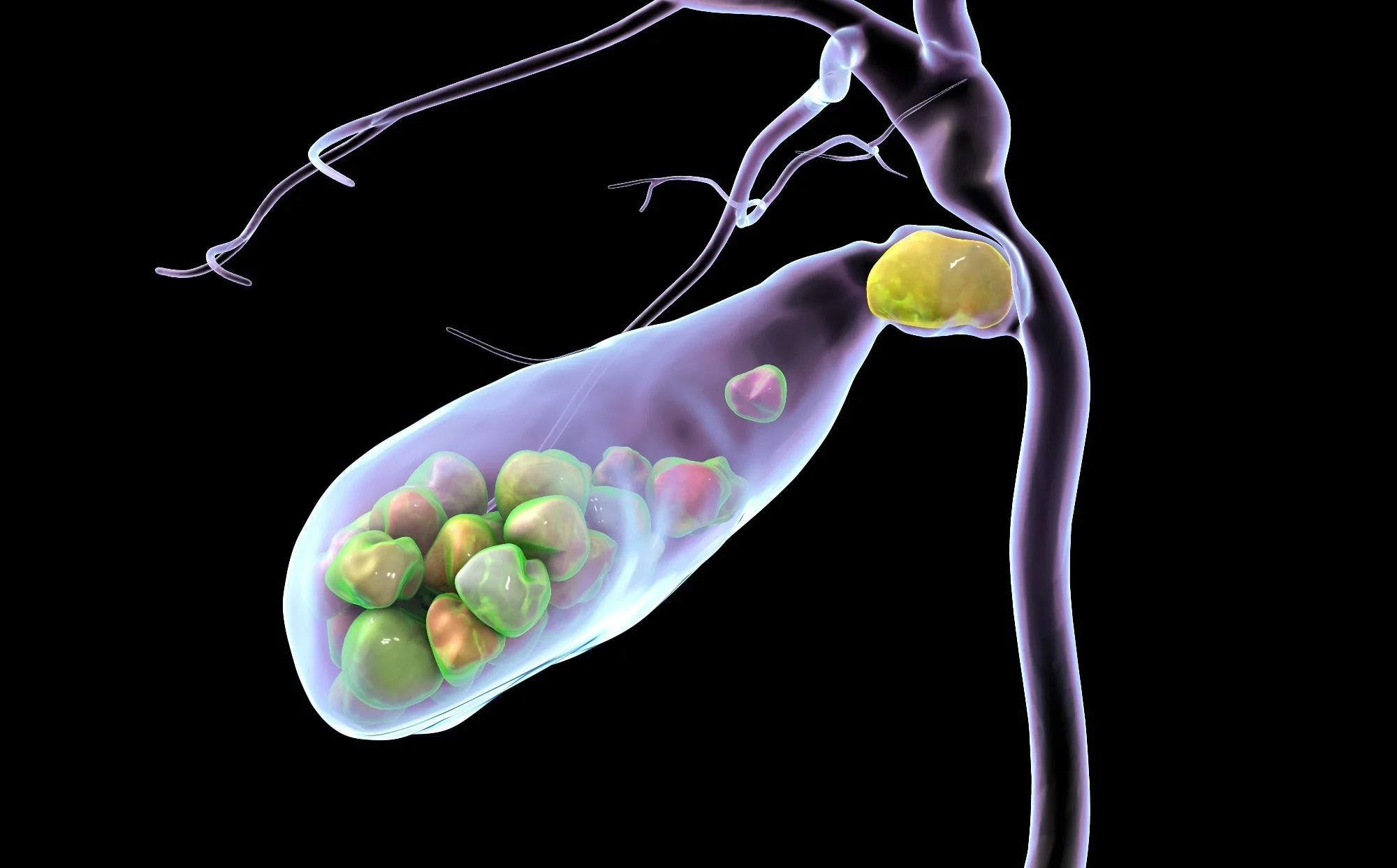 A digital illustration of a gall bladder with stones inside, connected to the bile ducts.
